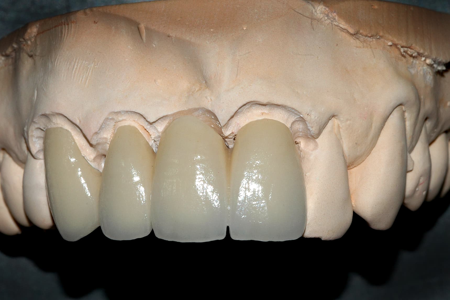 Anterior Restorations